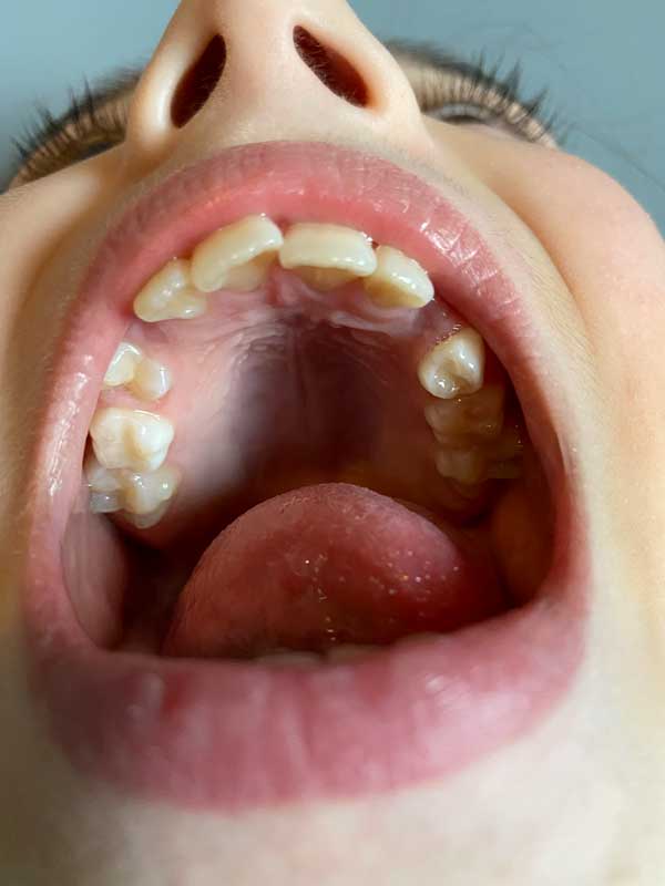 photo of upper teeth